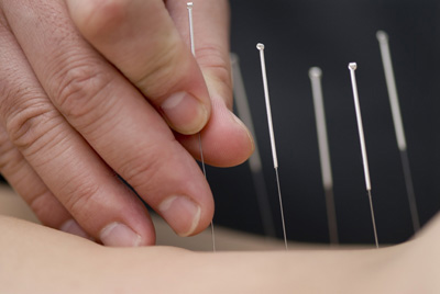 Acupuncture is Effective for Pain